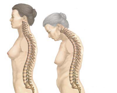 osteoporoza2